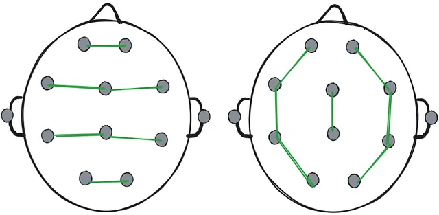 Examples of bipolar montage